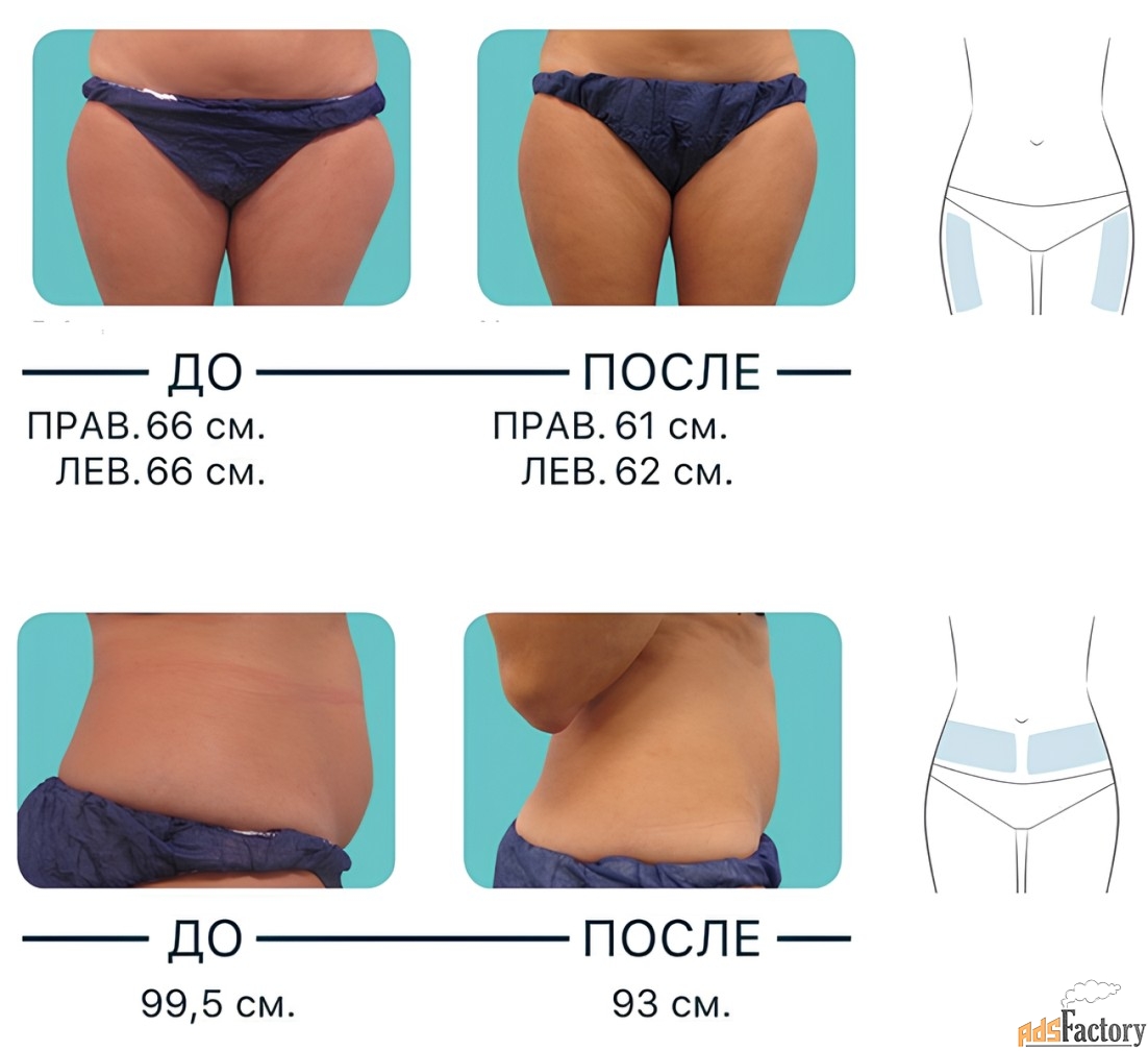 Криополиз - похудение без диет: уберём жировые клетки