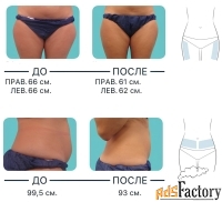 Криополиз - похудение без диет: уберём жировые клетки