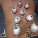 Хиджама исцеление без лекарств эффективно